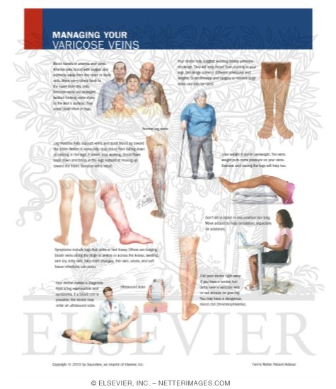 Watermarked preview of labeled image: Managing Your Varicose Veins