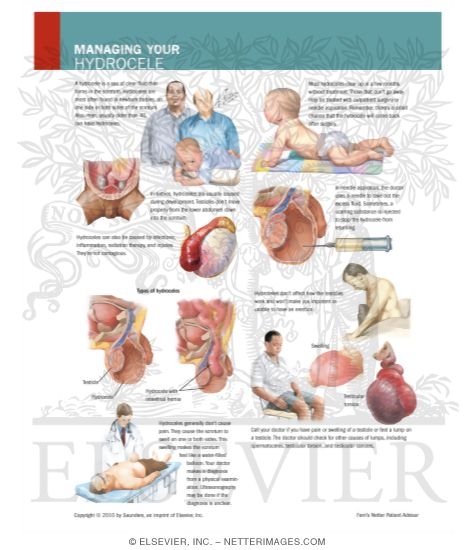 Watermarked preview of labeled image: Managing Your Hydrocele