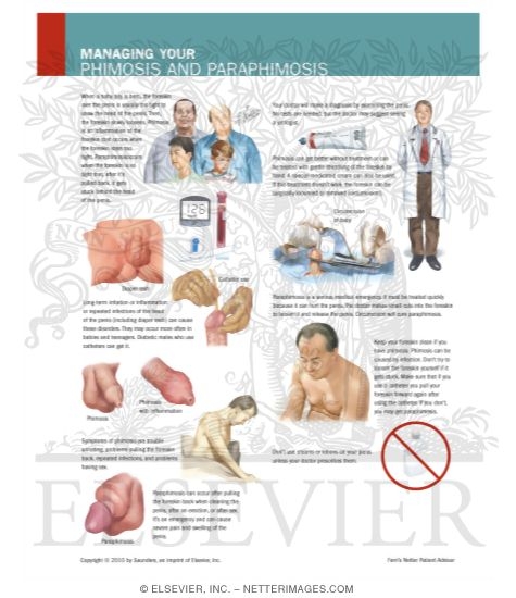 Managing Your Phimosis and Paraphimosis