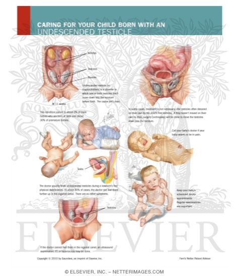 Caring for Your Child Born With An Undescended Testicle