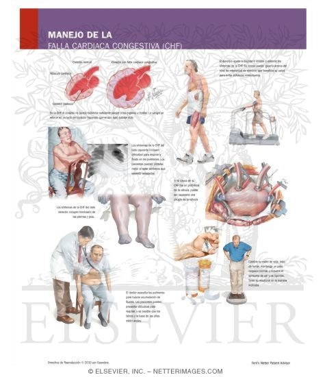 Watermarked preview of labeled image: Managing Your Congestive Heart Failure (CHF)