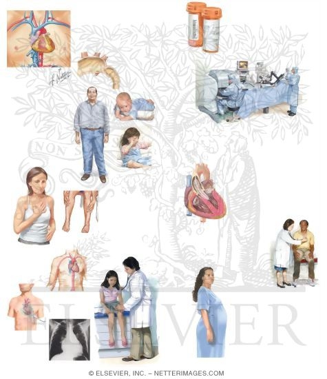Managing Your Coarctation Of The Aorta
