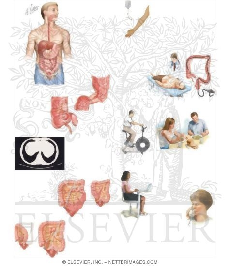 Watermarked preview of unlabeled image: Managing Your Colon Cancer