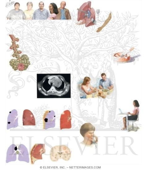 Watermarked preview of unlabeled image: Managing Your Lung Cancer