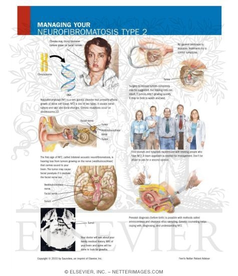 Managing Your Neurofibromatosis Type 2