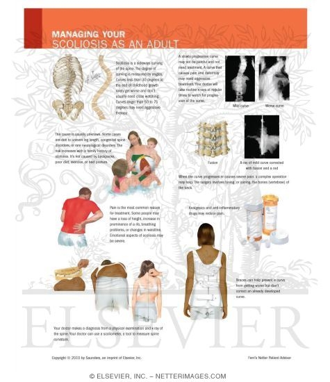 Watermarked preview of unlabeled image: Managing Your Scoliosis As an Adult