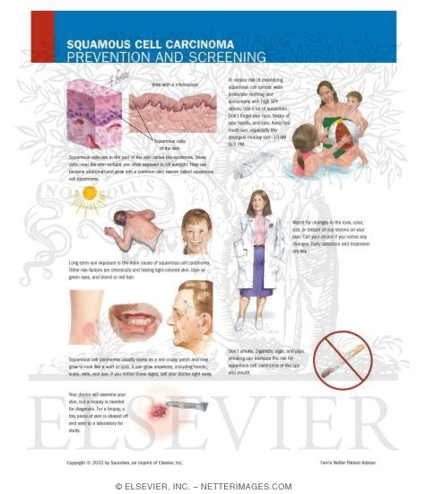 Squamous Cell Carcinoma: Prevention and Screening