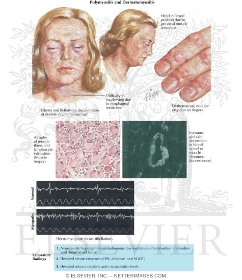 Watermarked preview of labeled image: Dermatomyositis and Polymyositis