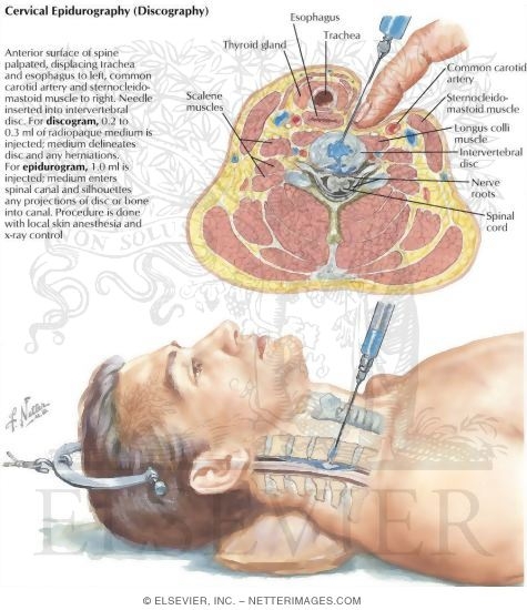 Cervical Epidurography (Discography)