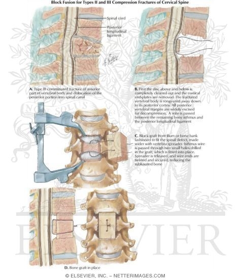 Watermarked preview of labeled image: Block Fusion for Types 2 and 3 Compression Fractures of Cervical Spine