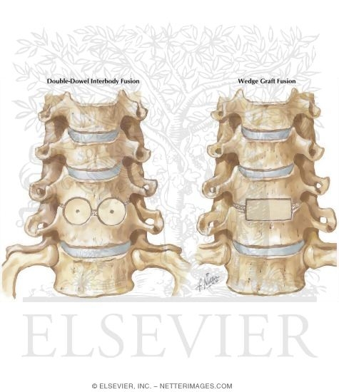 Double Dowel Interbody Fusion: Wedge Graft Fusion