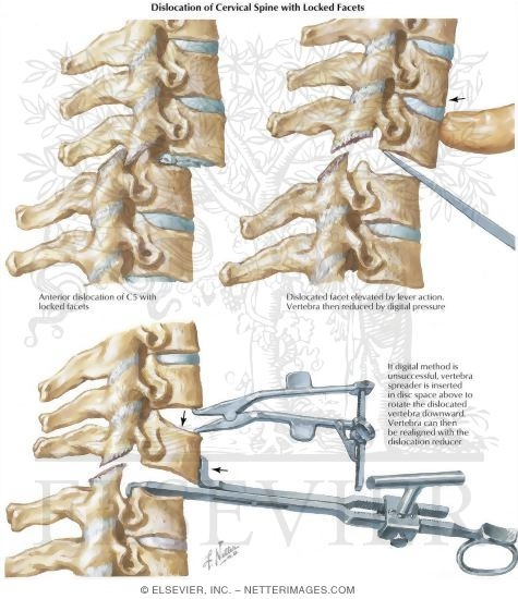 Watermarked preview of labeled image: Dislocation of Cervical Spine With Locked Facets