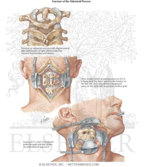 Watermarked preview of labeled image: Fracture of Odontoid Process