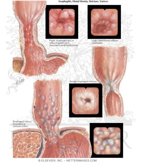 Watermarked preview of labeled image: Esophagitis: Varices