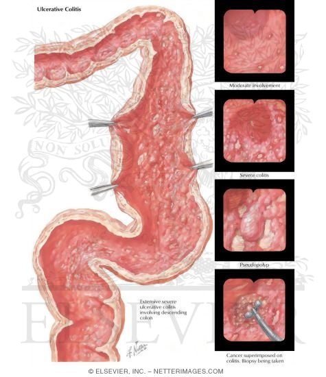 Watermarked preview of labeled image: Ulcerative Colitis