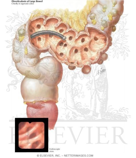 Watermarked preview of labeled image: Diverticulosis