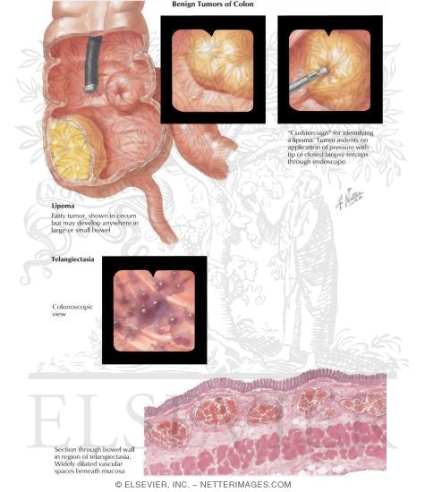 Watermarked preview of labeled image: Lipoma: Telangiectasia