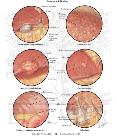 Laparoscopic Findings