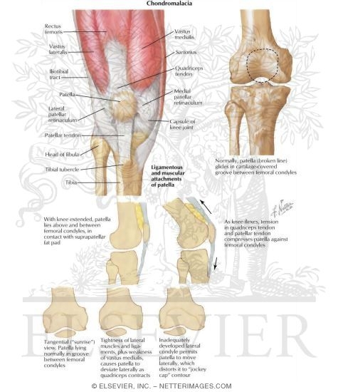 Watermarked preview of labeled image: Patellofemoral Stress Syndrome