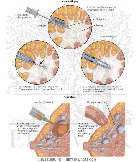 Watermarked preview of labeled image: Breast Tumors, Needle Biopsy, and Aspiration