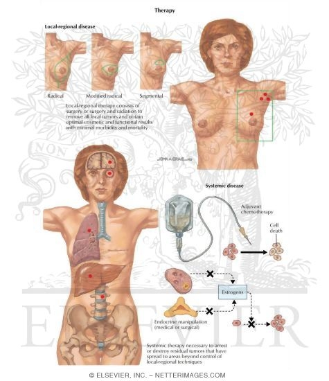 Watermarked preview of labeled image: Breast Surgery Cancer: Therapy