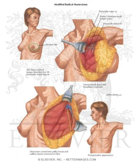 Breast Cancer Surgery: Modified Radical Mastectomy
