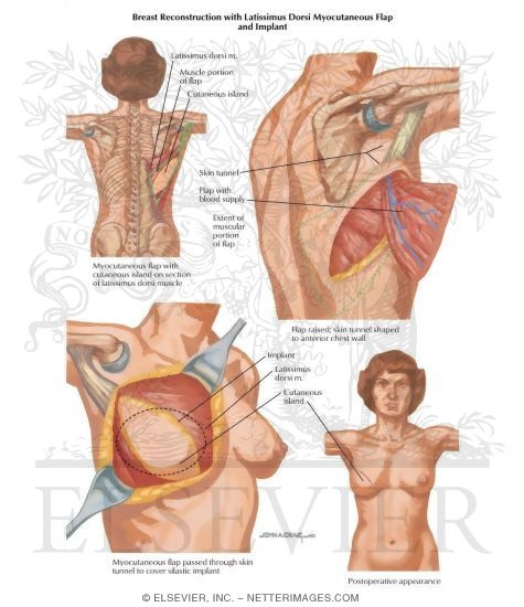 Breast Cancer Surgery: Breast Reconstruction With Latissimus Dorsi Myocutaneous Flap and Implant
