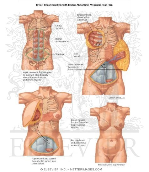 Watermarked preview of labeled image: Breast Cancer Surgery: Breast Reconstruction With Rectus Abdominus Myocutaneous