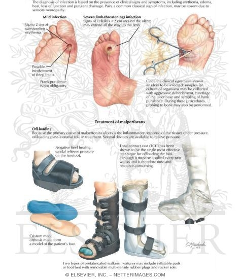 Watermarked preview of labeled image: Diagnosis and Treatment of Ulcer Infections