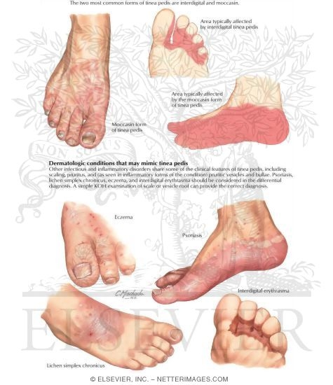 Diagnosis of Tinea Pedis