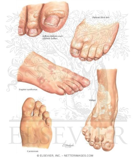 Noninfectious Cutaneous Manifestations of the Lower Extremity