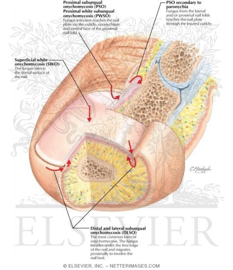 Watermarked preview of labeled image: Onychomycosis: Classification By Portals of Entry