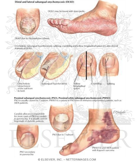 Clinical Examples of Onychomycosis