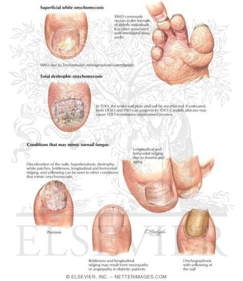 Clinical Examples of Onychomycosis