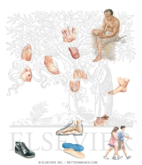 Watermarked preview of unlabeled image: Foot Care for People With Diabetes