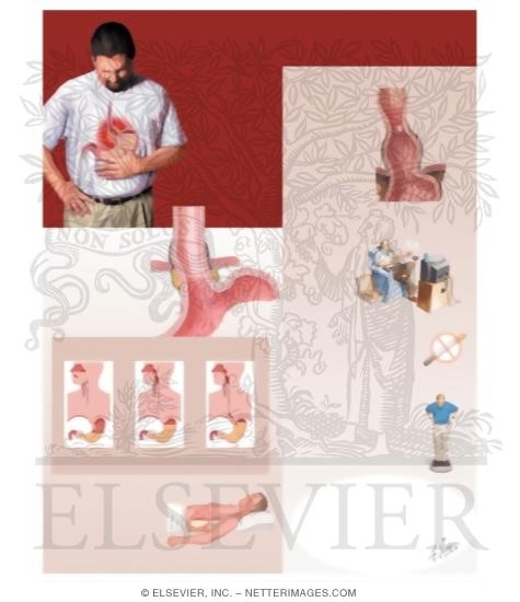 Watermarked preview of unlabeled image: Understanding Gastroesophageal Reflux Disease (GERD)