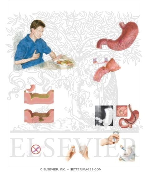 Watermarked preview of unlabeled image: Peptic Ulcer Disease