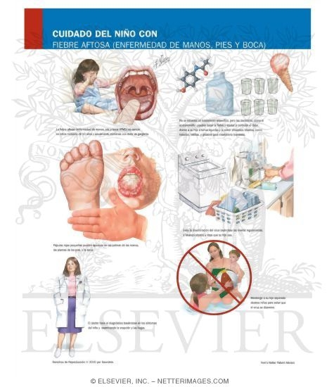 Watermarked preview of labeled image: Caring for Your Child With Hand, Foot, and Mouth Disease