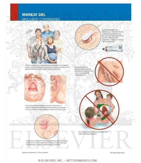 Managing Your Molluscum Contagiosum