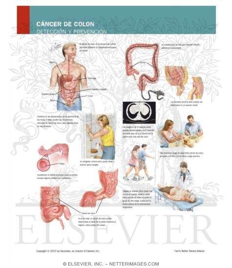 Watermarked preview of labeled image: Colon Cancer: Screening and Prevention