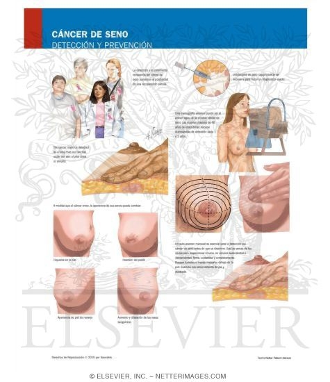 Watermarked preview of labeled image: Breast Cancer Screening and Prevention