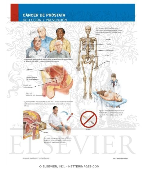 Prostate Cancer Screening and Prevention