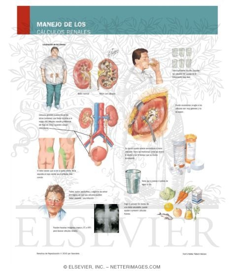 Watermarked preview of labeled image: Managing Your Kidney Stones