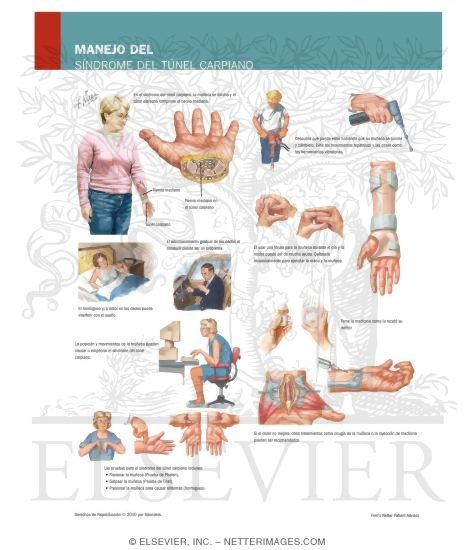 Managing Your Carpal Tunnel Syndrome