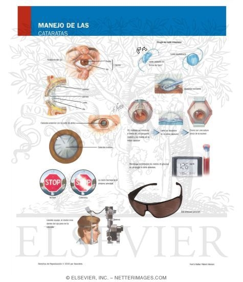 Watermarked preview of labeled image: Managing Your Cataracts