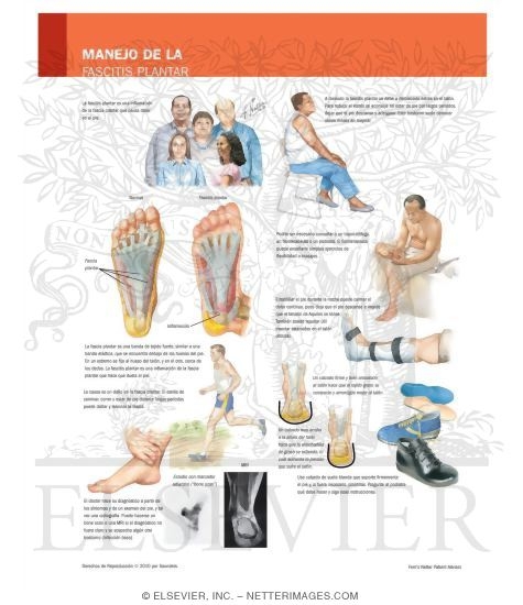 Watermarked preview of labeled image: Managing Your Plantar Fasciitis
