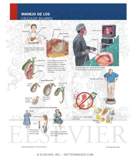 Watermarked preview of labeled image: Managing Your Gallstones