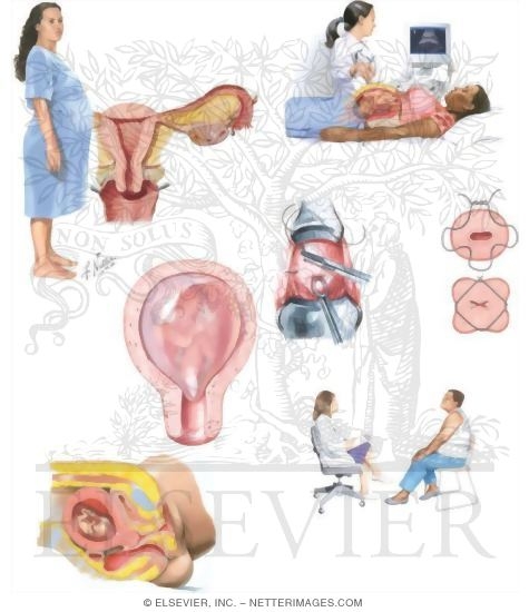 Watermarked preview of unlabeled image: Managing Your Cervical Incompetence