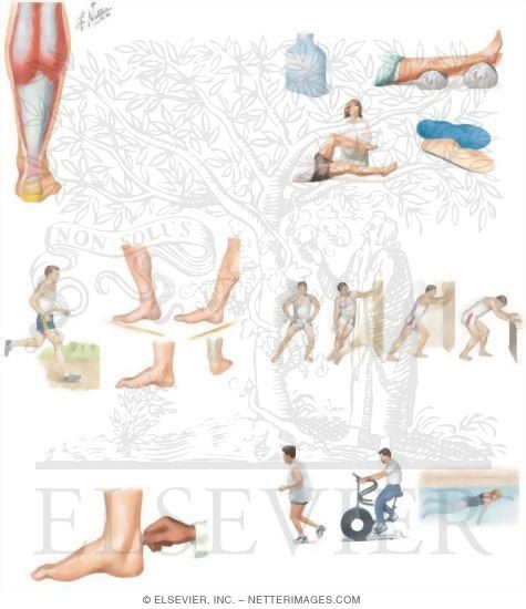 Watermarked preview of unlabeled image: Managing Your Achilles Tendinitis