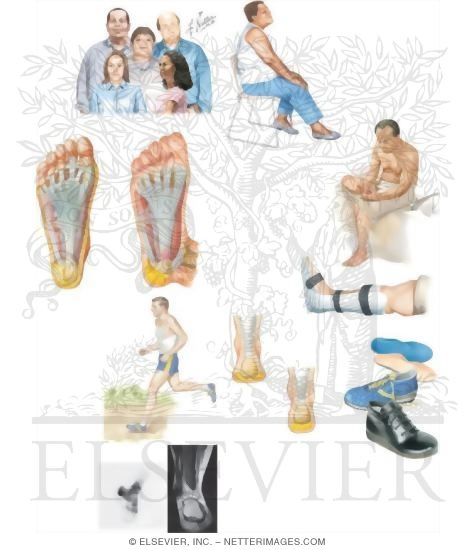 Watermarked preview of unlabeled image: Managing Your Plantar Fasciitis